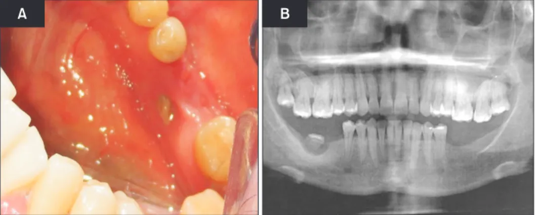 Fig. 1. A. Patient treated with zoledron- zoledron-ic acid with left lingual bone exposure  table and no signs of soft tissue  infec-tion