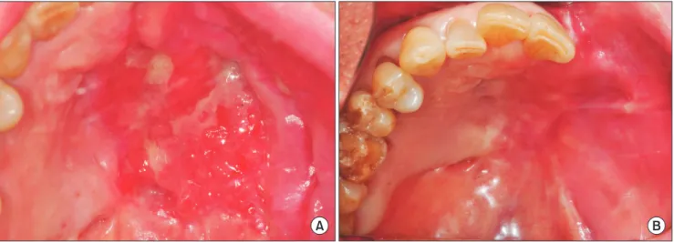Fig. 5. Re-epithelialization of the grafted buccal fat pad 20 days (A) and 8 weeks (B) after surgery.