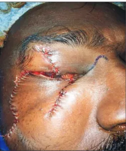Fig. 2. Reconstruction using local cheek advancement flap.