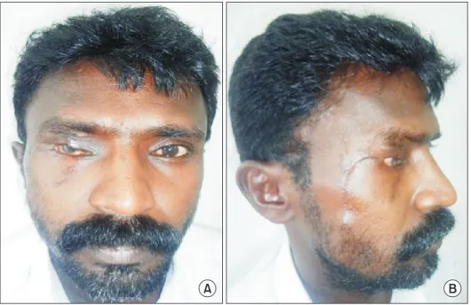 Fig. 3. Postoperative photographs at  6 months. A. Frontal view. B. Lateral  view.