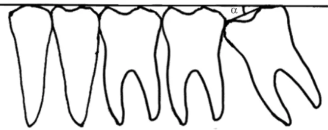 Fig. 1. Classification of mandibular third molar angulation based  on the method of Shiller