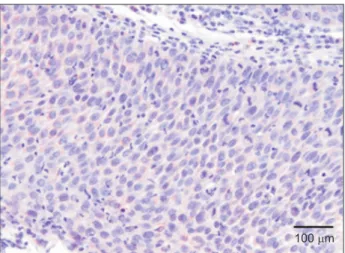 Fig. 1. Immunohistochemical staining of vascular endothelial  growth factor of oral carcinoma  in situ  (×200).