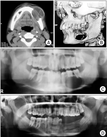 Fig. 1. A. Preoperative axial computed tomography (CT) shows  unilocular lucency involving the left mandibular body with a large  exophytic component