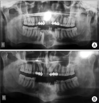 Fig. 3. A. Preoperative panoramic radiograph shows unilocular  lucency extending from the mesial surface of the left mandibular  canine to the mesial surface of the right 2nd premolar along with  impacted #43 and #44
