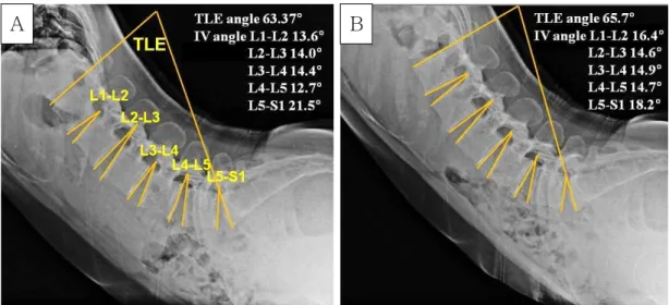Figure  1.  The X-ray images of the LE assessment; the total LE angle and the intervertebral angles were measured in lumbar extension position (A : LE position without ADIM, B : LE position with ADIM) (LE : lumbar extension, ADIM : abdominal drawing-in man