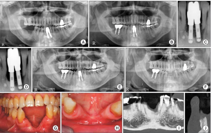 Fig. 1. Panorama, periapical X-ray and clinical views. A. Initial visit. B. Four years after the initial visit