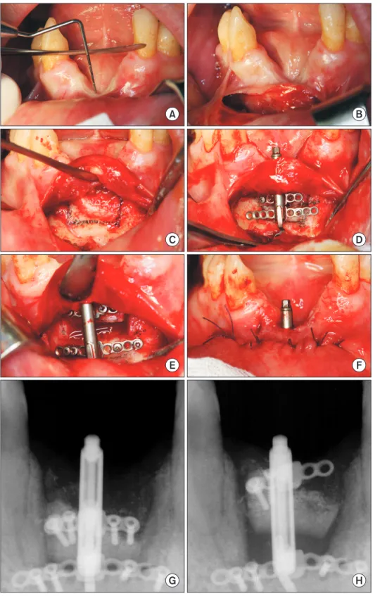 Fig. 2. Clinical views and periapical X- X-ray. A. Measurement of vertical defect  before the distraction osteogenesis  (DO) procedure