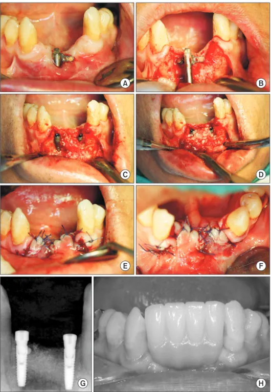 Fig. 3. Clinical views and periapical X- X-ray. A, B. Incision and flap reflection. C