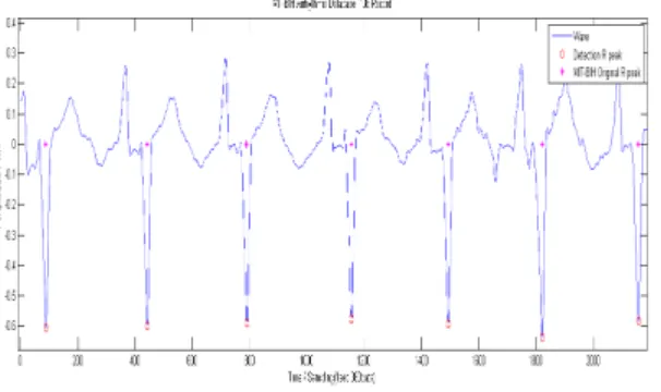 그림 12. MIT-BIH ADB 108번 레코드 Fig. 12. MIT-BIH arrhythmia database 108 record