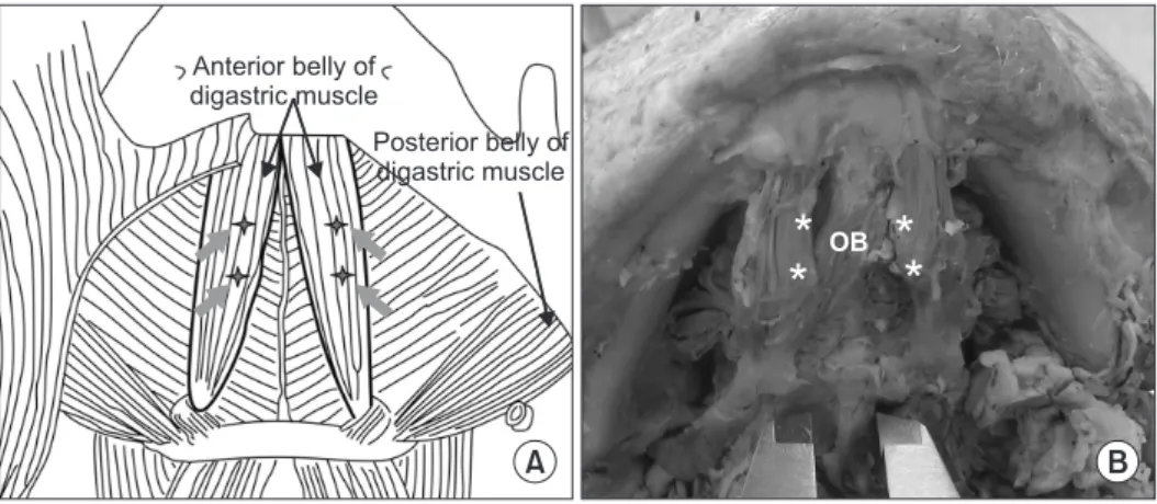 Fig. 1. Side-by-side comparison between normal and variant anterior digastric musculature with regard to botulinum toxin type A (BTX-A)  injection sites