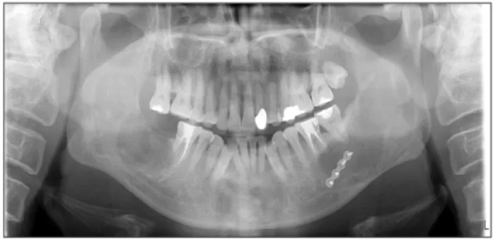 Fig. 3. Left side enucleated mass with teeth of case 1.