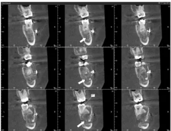 Fig. 8. Postoperative cone-beam computed tomography of case  2 (#37 tooth) (5-month follow-up).