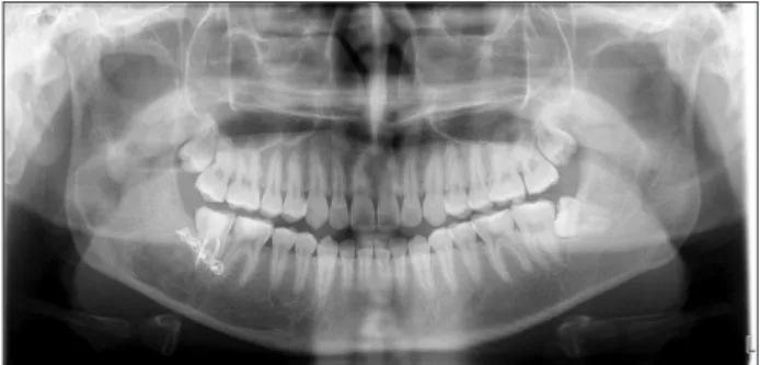 Fig. 9. Preoperative panoramic radiograph of case 3.