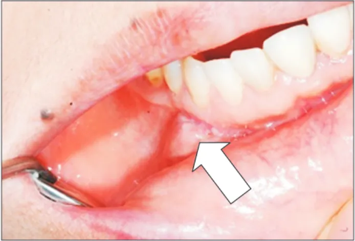 Fig. 3. Intraoral photograph after mass excision showing inferior  alveolar nerve branches.