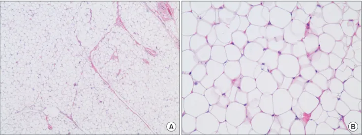 Fig. 5. A. Microscopic view, showing mature adipose cells (H&amp;E staining, ×40). B. Microscopic view, showing mature adipose cells (H&amp;E  staining, ×200).