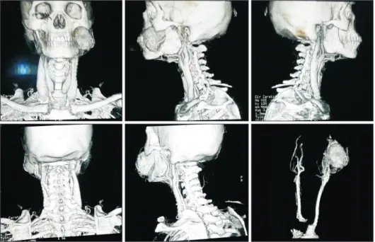 Fig. 2. Computed tomography angio- angio-gram.