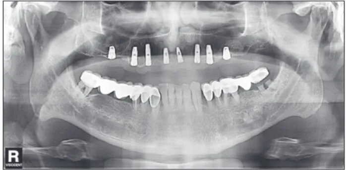 Fig. 1. Panoramic radiograph after insertion of the implants.