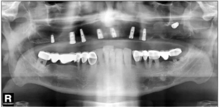 Fig. 3. Computed tomography images after the implant disappeared.