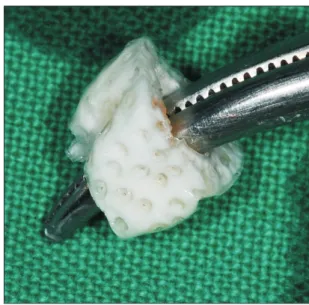 Fig. 11. The occlusal view of the autogenous tooth bone graft  block.