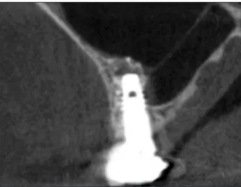 Fig. 17. Cone-beam computed tomography four years later.
