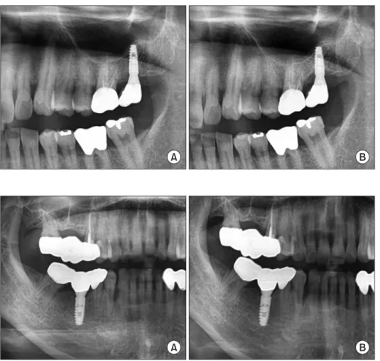 Fig. 1. A. One dental implant was  placed at the maxillary left second  molar site with an osteotome sinus  el-evation technique in 2010
