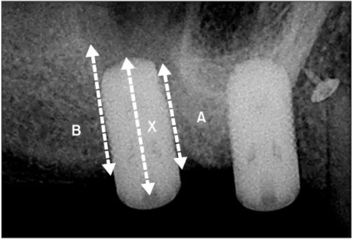 Fig. 1. Radiographic measurement of residual bone height (A: 
