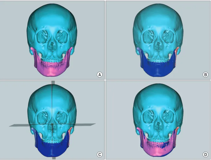 Fig. 2. Mandibular simulation surgery. A. Preoperative three-dimensional (3D) skeletal image overlapped with current occlusion digital cast  images