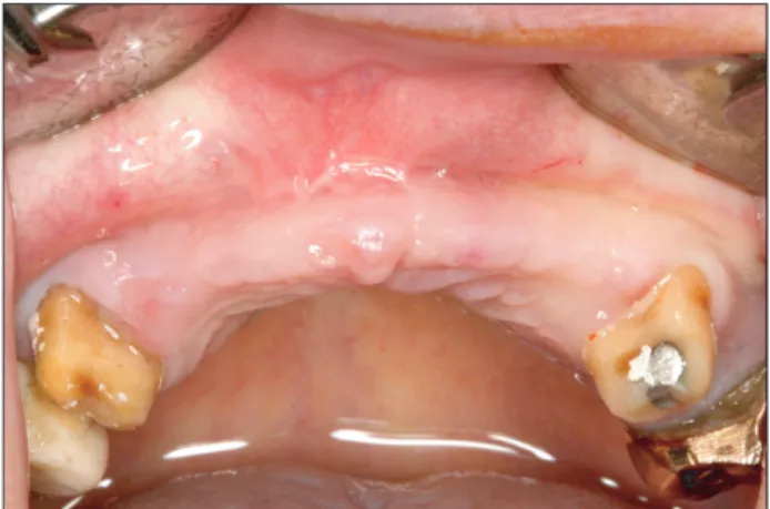 Fig. 2. A panorama radiograph at the initial diagnosis. The dentist  at another clinic was expected to place implants in the #13 and 