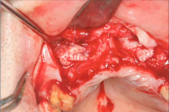 Fig. 6. The appearance after grafting powder-type bone-graft ma- ma-terials in the vicinity of the block.