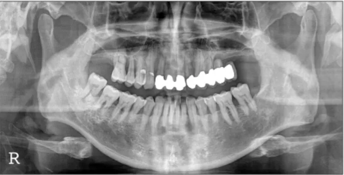 Fig. 12. A panorama radiograph after implant placement. Implants  were placed 3 months after bone graft.