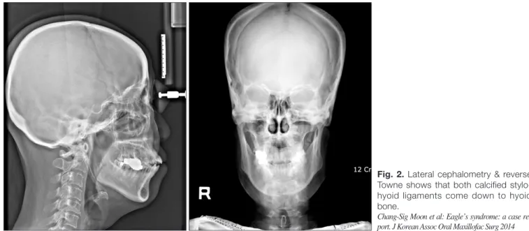 Fig. 2. Lateral cephalometry &amp; reverse  Towne shows that both calcified  stylo-hyoid  ligaments  come  down  to  stylo-hyoid  bone.