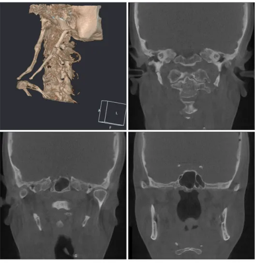 Fig. 3. Cone-beam computed tomogra- tomogra-phy shows that both calcified stylohyoid  ligaments are more longer than 60 mm