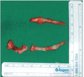 Fig. 7. Cone-beam computed tomogra- tomogra-phy after surgery shows that both  calci-fied  stylohyoid  ligaments  were  almost  removed.
