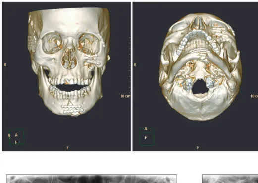 Fig.  3.  Computed  tomography  two  months after surgery in Department of  Otolaryngology.