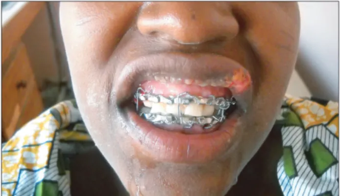 Fig. 6. Restoration of normal occlusion following bite block trac- trac-tion. Note the upper lip injury from wire trauma.
