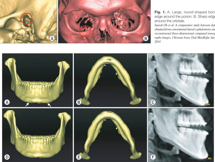 Fig. 2. A. Downward extended adjacent structure on both sides (white arrows). B. Position of the menton (Me) in the inferior-superior di- di-rection