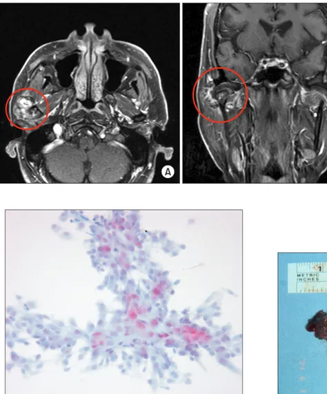 Fig. 5. The axial (A) and coronal (B) fat  suppression  T1-weighted  images  of   magnetic resonance imaging show the  multilobulated high signal intensity with  the high soft tissue enhancement