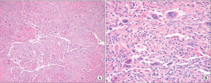 Fig. 8. The mass is composed of many mononuclear histiocytic cells and irregularly interspersed multinucleated giant cells