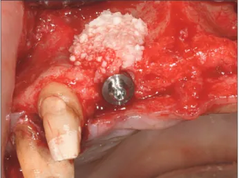 Fig. 5. The preformed titanium mesh was easily removed under  the minimum flap elevation at postoperatively 4-month re-entry.