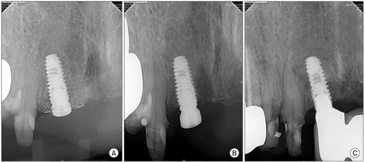 Fig. 7. Comparison of periapical radiographs taken at the application (A) and removal (B) of the preformed titanium mesh and at 1 year af- af-ter delivery of the final prosthesis (C).