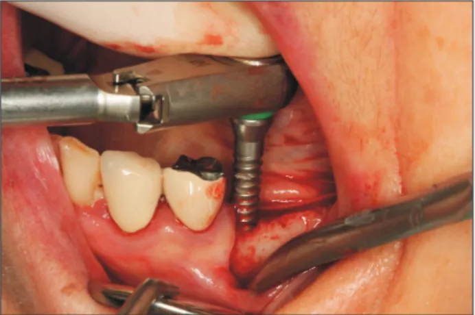 Fig. 8. Expansion of buccal plate achieved by splitting the ridge  using the bone expander in SplitMaster (Mr