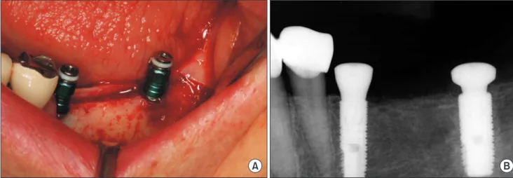Fig. 11. Periapical radiograph 63 months after implant placement.