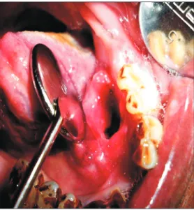 Fig. 2. Orthopantomogram does not reveal any changes in the  region of interest.