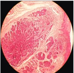 Fig. 5. Wide excision of the lesion with hemimandibulectomy was  completed.