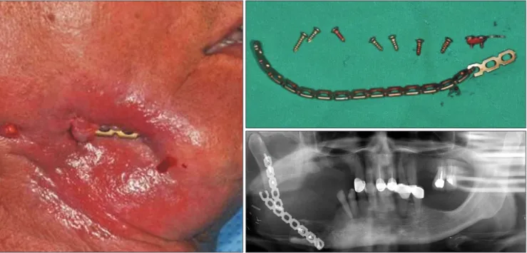 Table 1. Disease processes underlying mandibular discontinuity  defect cases