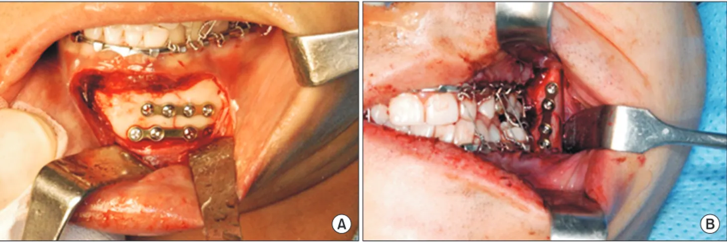 Fig. 1. Placement of titanium plates and screws in symphysis (A) and angle area (B).