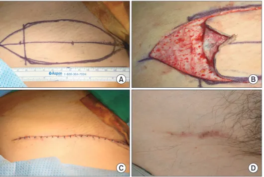 Table 1 and Table 2 show the distribution of the recipient  sites of skin grafts. The width of skin was distributed from  2 cm to 8 cm (mean: 5.1 cm); the long axis length of the  groin was distributed from 3 cm to 13 cm (mean: 7.4 cm)