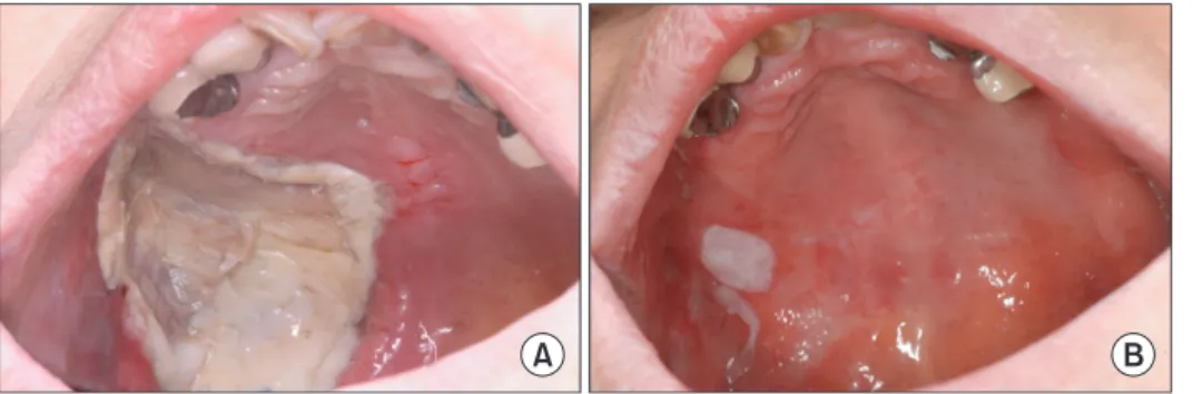 Fig. 3. Healing status of the recipient site (donor site of radial  forearm free flap) 4 months after the surgery.