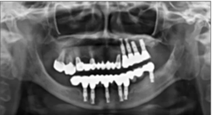 Fig.  6.  Tissue  expander  was  inserted  into  the  mandibular  edentulous ridge with the tunneling method