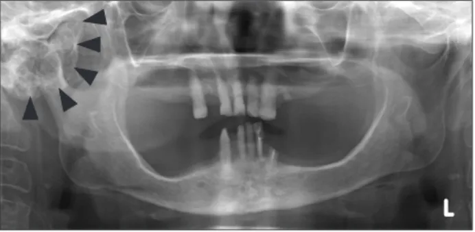 Fig. 1. Initial panoramic view shows round radiopaque mass on  the right mandibular condyle with jaw deviation (arowheads).